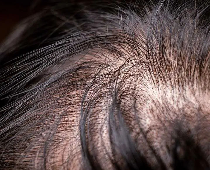 GFC Hair treatment in delhi